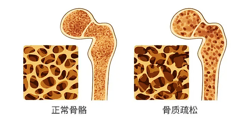 骨密度检测